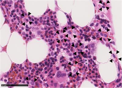 Case report: Hemorrhagic fever with renal syndrome presenting as hemophagocytic lymphohistiocytosis